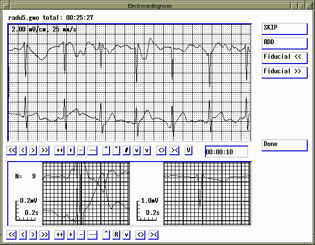 P wave screen